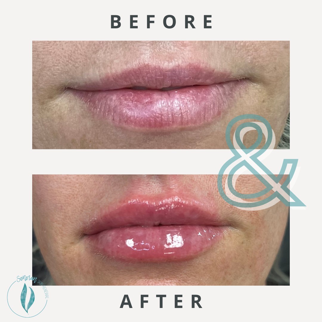Lip filler before and after — added volume, definition and hydration — Sonoran Skin Renewal, Scottsdale AZ