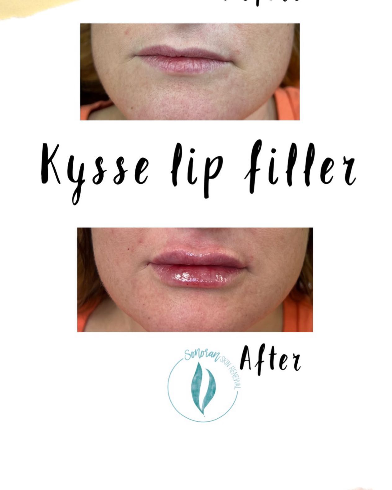 Lip filler before and after — added volume, definition and hydration — Sonoran Skin Renewal, Scottsdale AZ