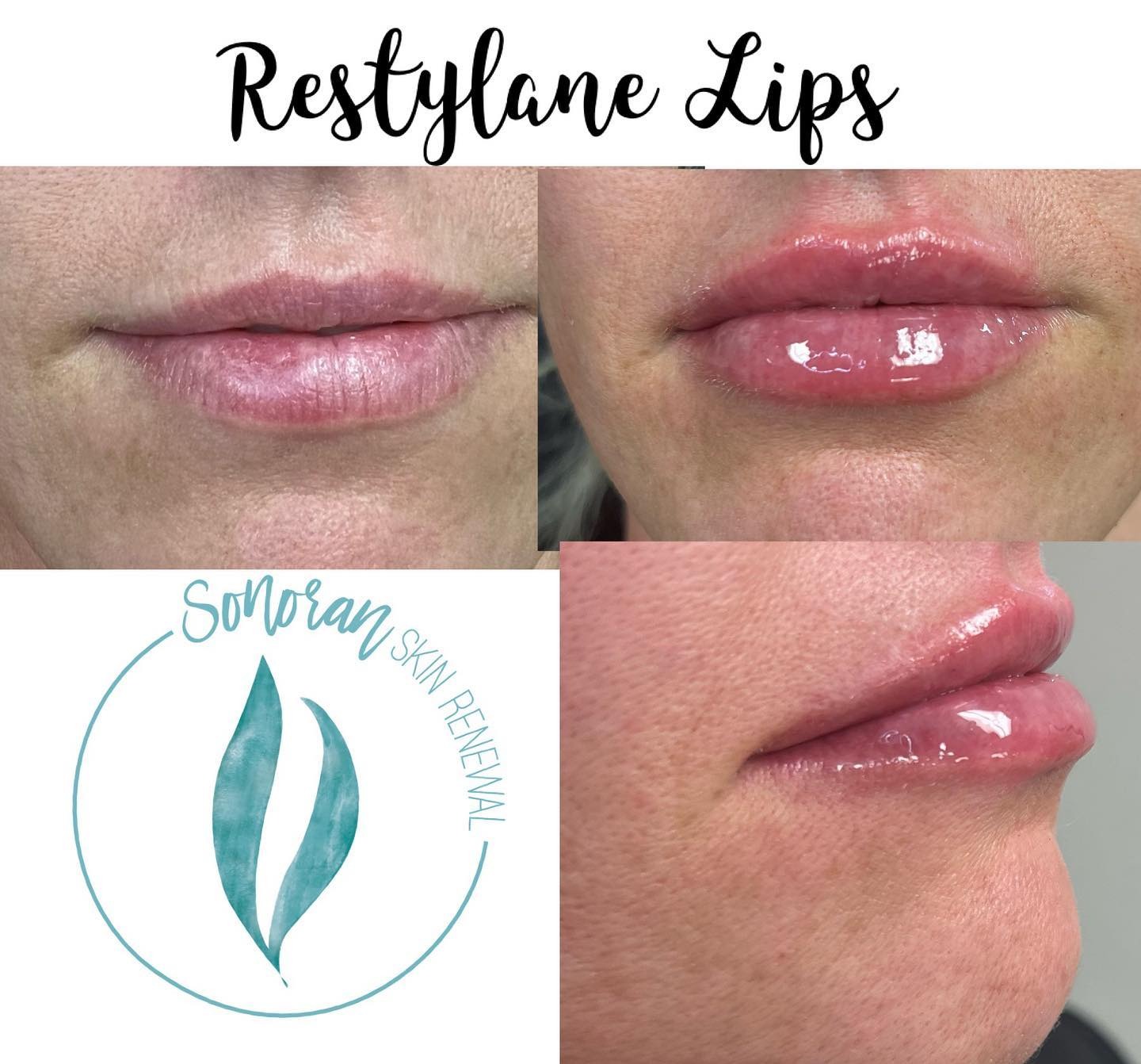 Lip filler before and after — added volume, definition and hydration — Sonoran Skin Renewal, Scottsdale AZ