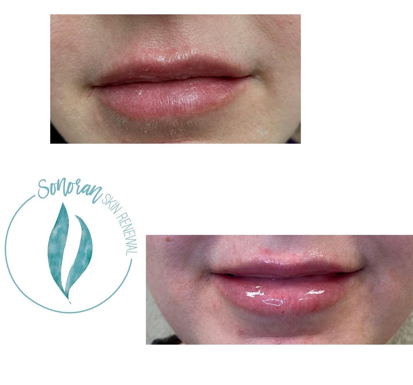 Lip filler before and after — added volume, definition and hydration — Sonoran Skin Renewal, Scottsdale AZ