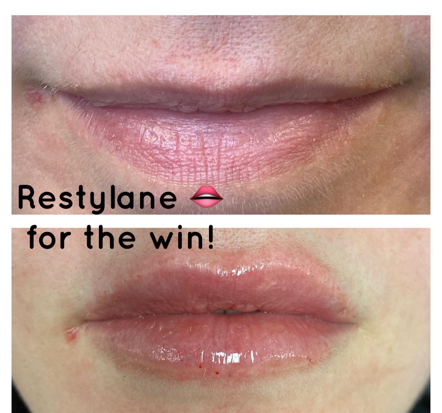 Lip filler before and after — added volume, definition and hydration — Sonoran Skin Renewal, Scottsdale AZ