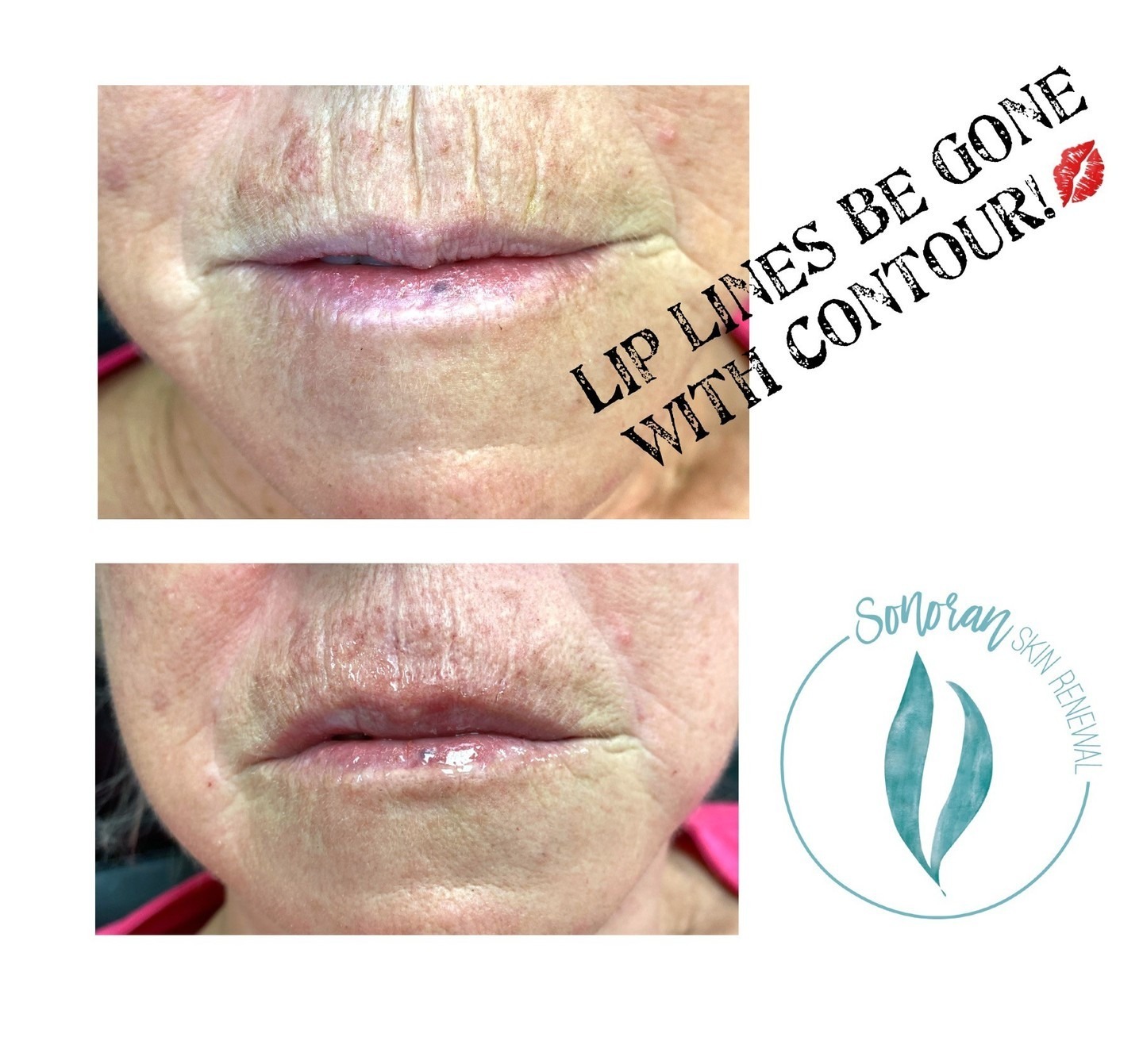Lip filler before and after — added volume, definition and hydration — Sonoran Skin Renewal, Scottsdale AZ
