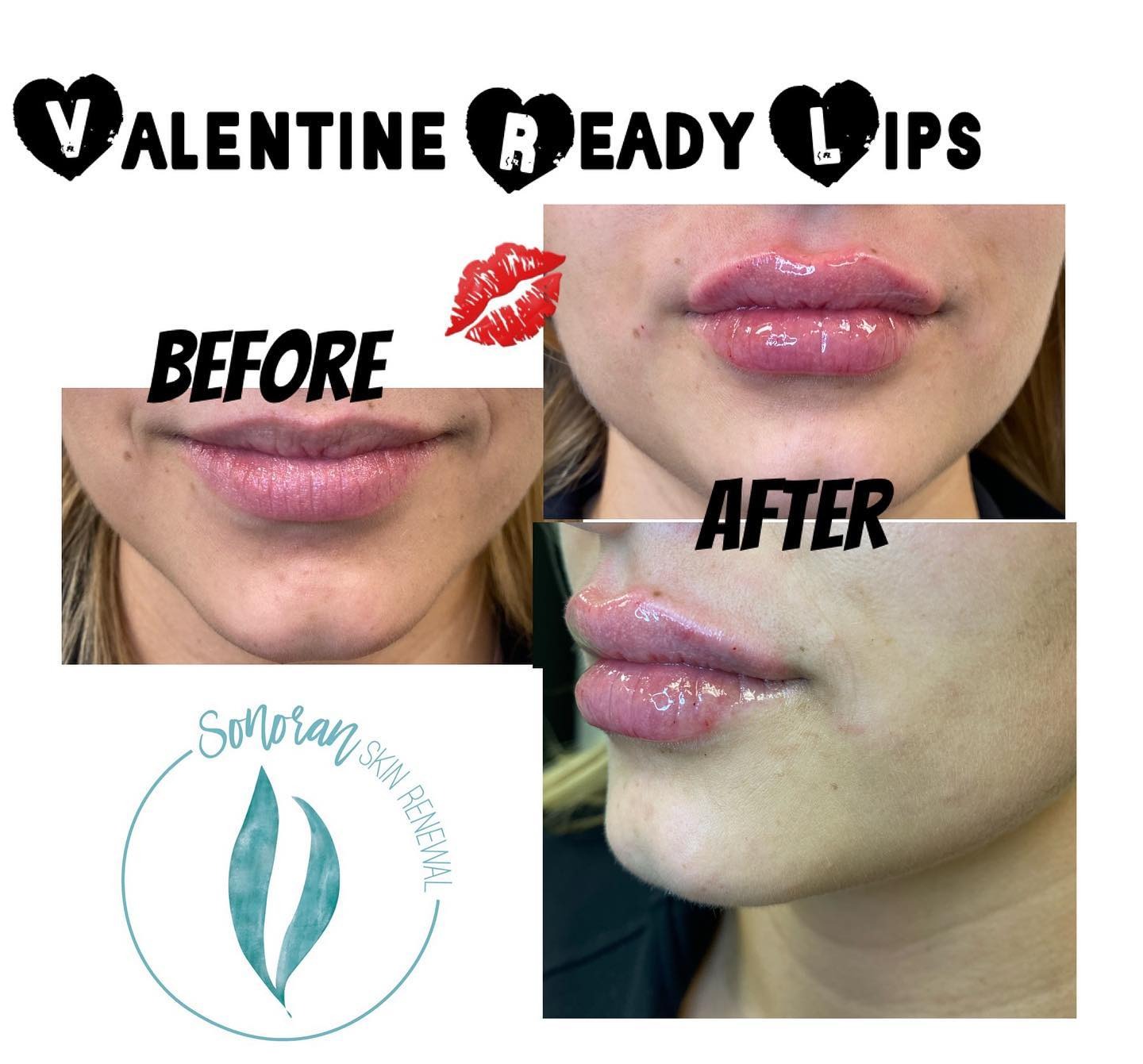 Lip filler before and after — added volume, definition and hydration — Sonoran Skin Renewal, Scottsdale AZ