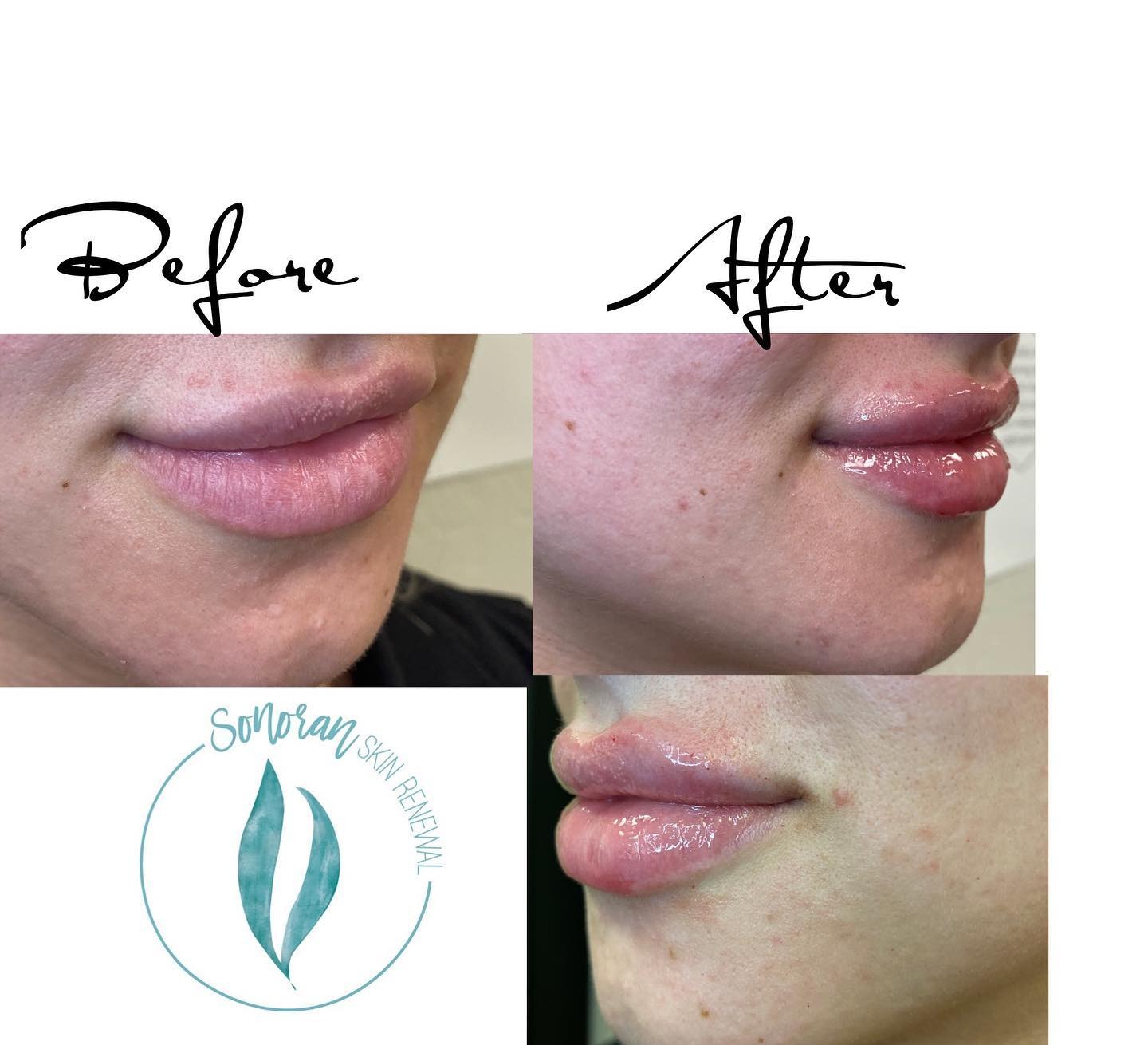 Lip filler before and after — added volume, definition and hydration — Sonoran Skin Renewal, Scottsdale AZ