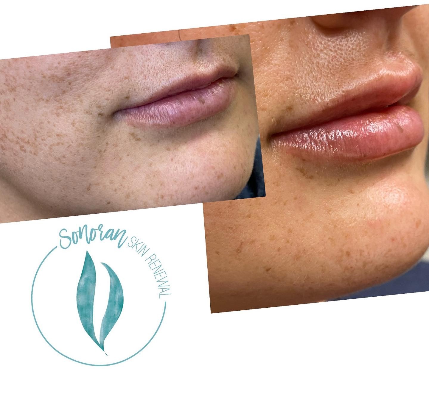 Lip filler before and after — added volume, definition and hydration — Sonoran Skin Renewal, Scottsdale AZ