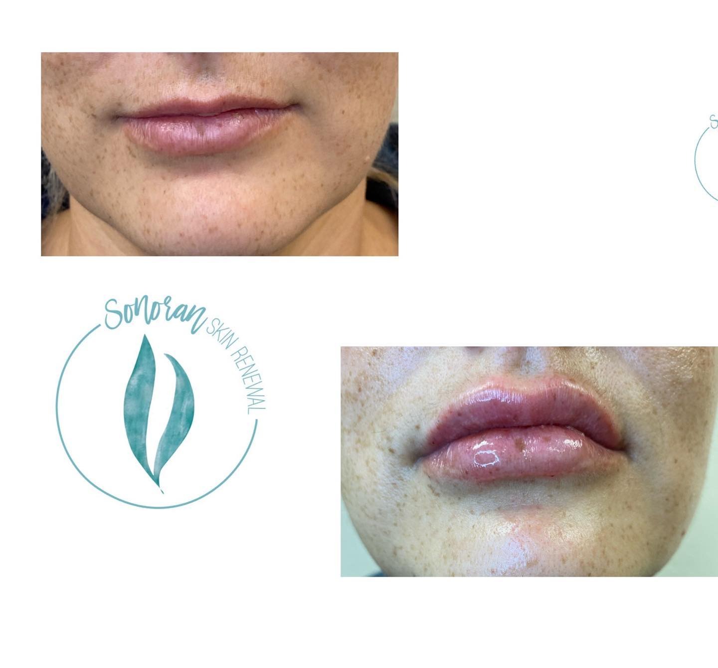 Lip filler before and after — added volume, definition and hydration — Sonoran Skin Renewal, Scottsdale AZ