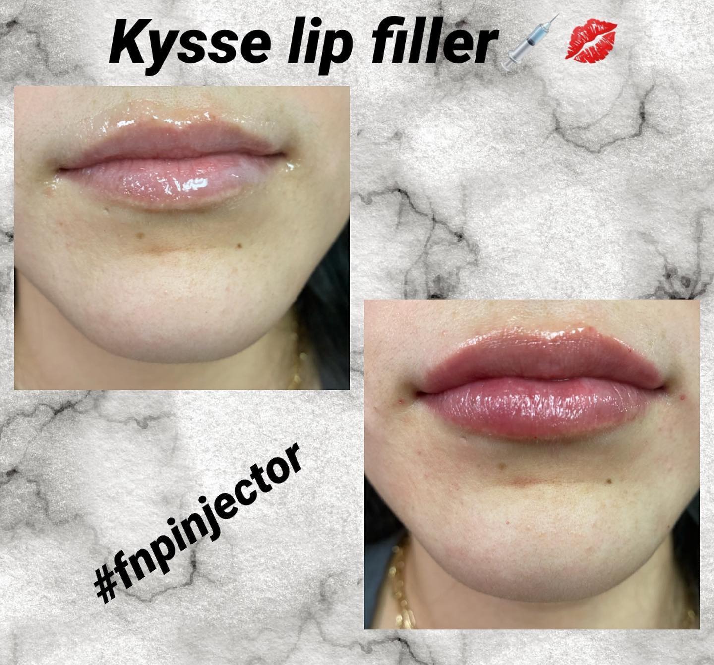 Lip filler before and after — added volume, definition and hydration — Sonoran Skin Renewal, Scottsdale AZ