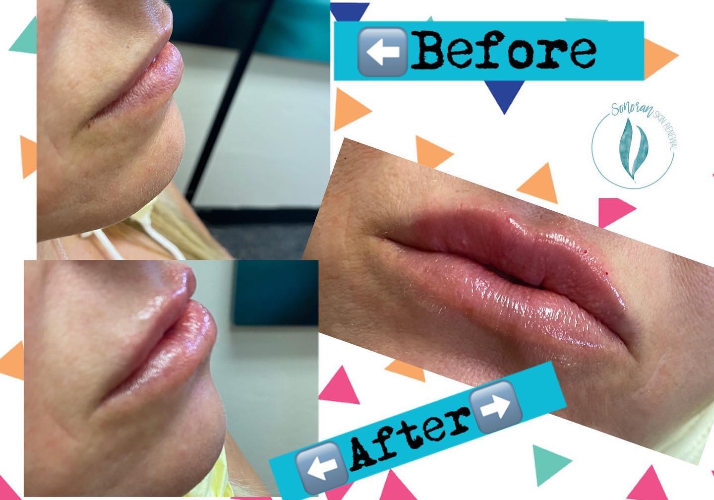 Lip filler before and after — added volume, definition and hydration — Sonoran Skin Renewal, Scottsdale AZ