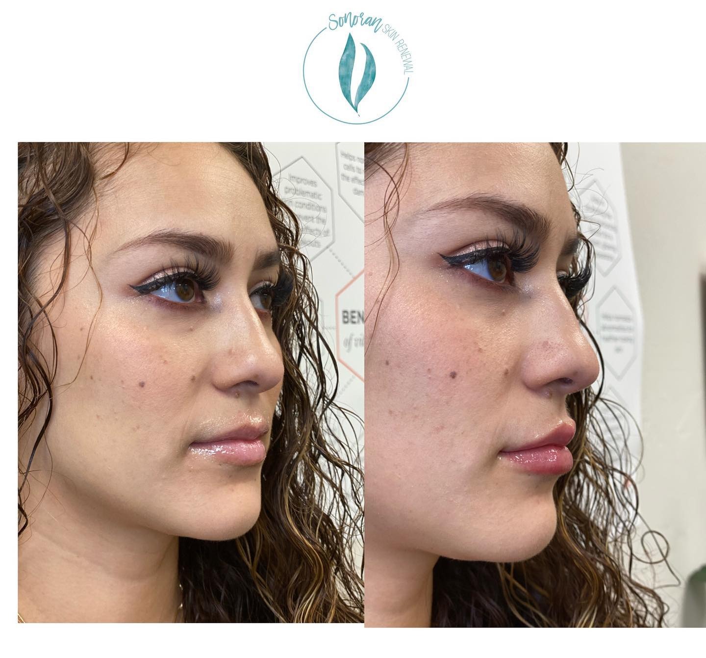 Lip filler before and after — added volume, definition and hydration — Sonoran Skin Renewal, Scottsdale AZ