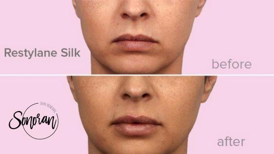 Lip filler before and after — added volume, definition and hydration — Sonoran Skin Renewal, Scottsdale AZ