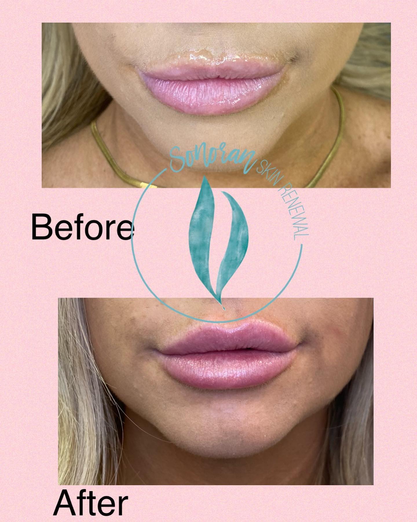 Lip filler before and after — added volume, definition and hydration — Sonoran Skin Renewal, Scottsdale AZ