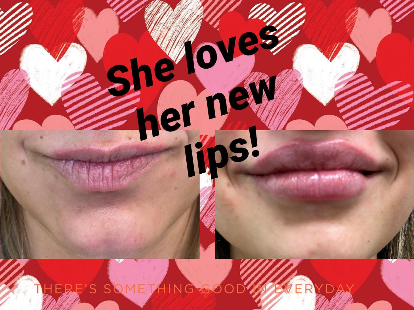 Lip filler before and after — added volume, definition and hydration — Sonoran Skin Renewal, Scottsdale AZ