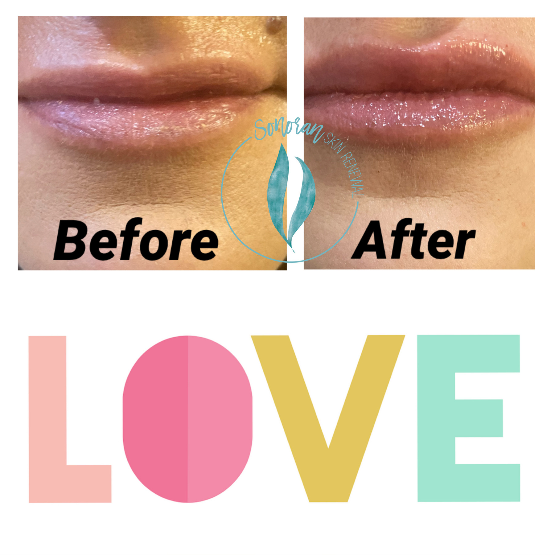 Lip filler before and after — added volume, definition and hydration — Sonoran Skin Renewal, Scottsdale AZ