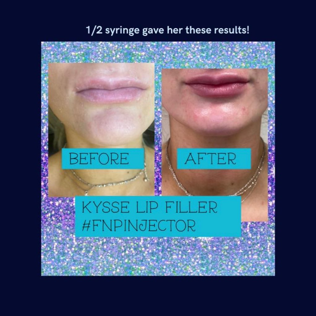 Lip filler before and after — added volume, definition and hydration — Sonoran Skin Renewal, Scottsdale AZ