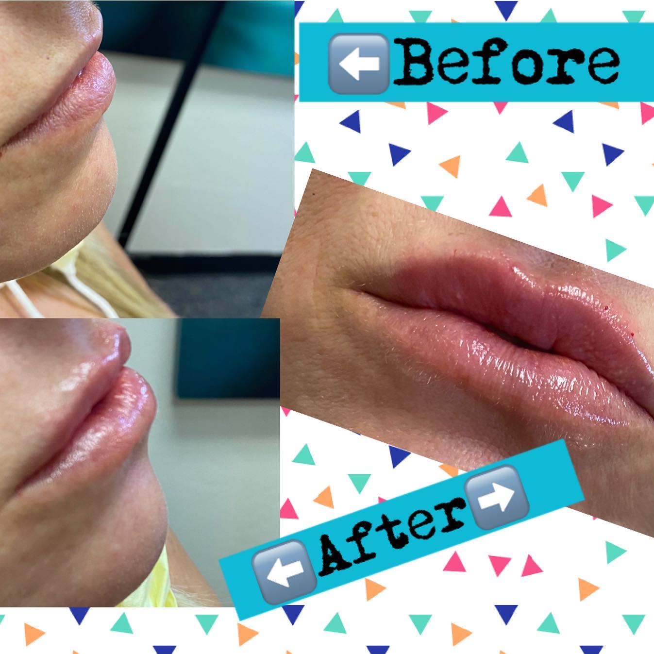 Lip filler before and after — added volume, definition and hydration — Sonoran Skin Renewal, Scottsdale AZ