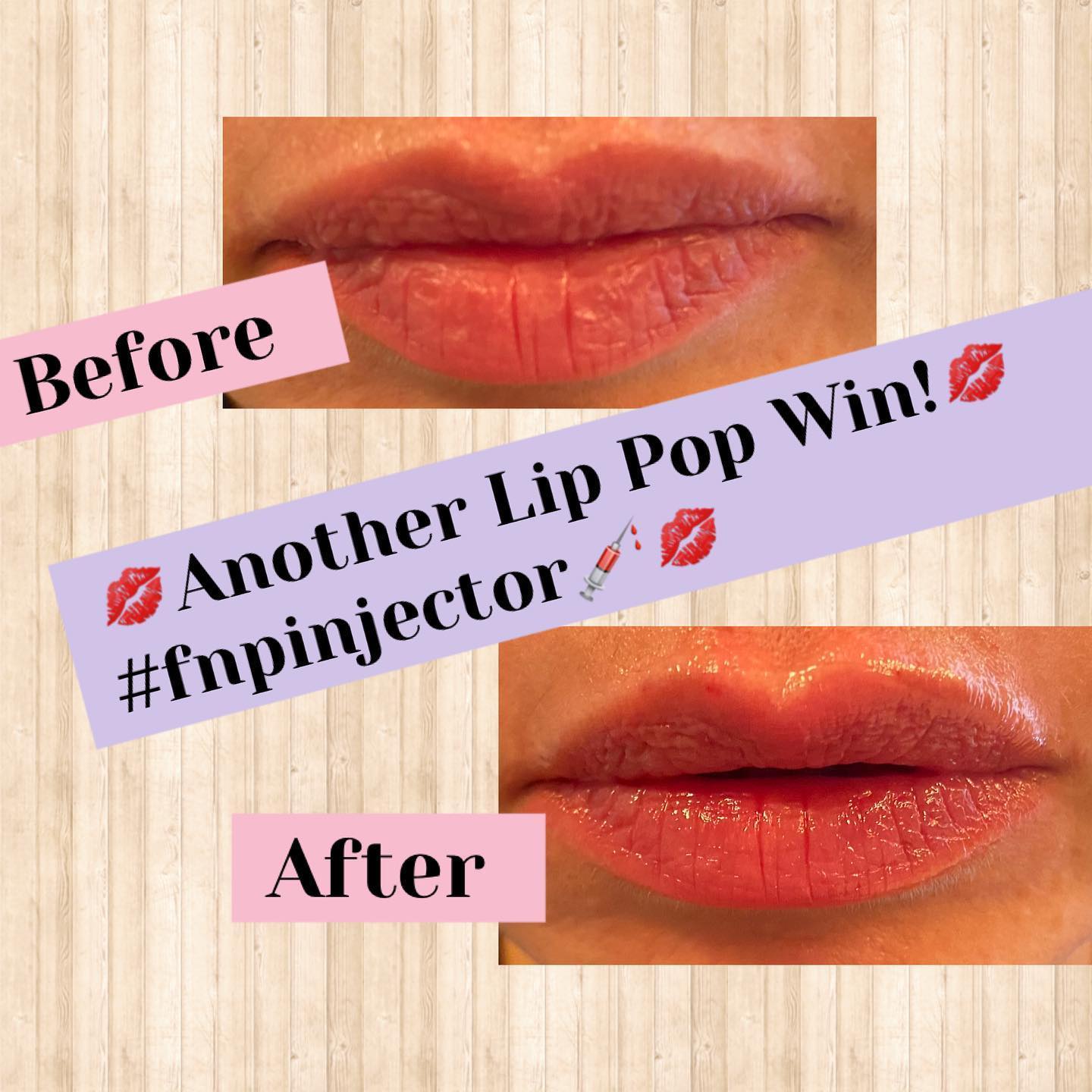 Lip filler before and after — added volume, definition and hydration — Sonoran Skin Renewal, Scottsdale AZ