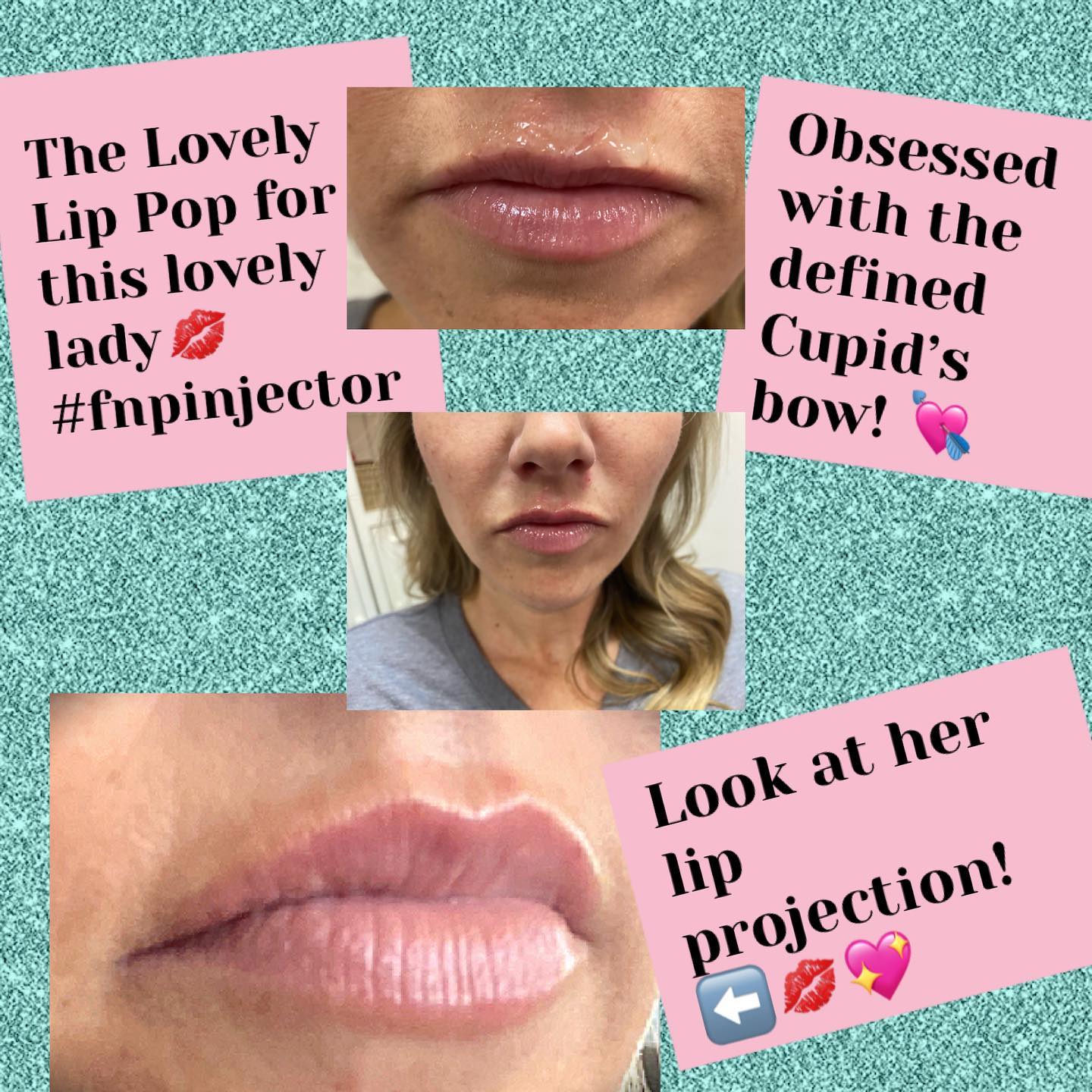 Lip filler before and after — added volume, definition and hydration — Sonoran Skin Renewal, Scottsdale AZ