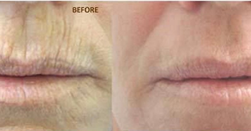 Lip filler before and after — added volume, definition and hydration — Sonoran Skin Renewal, Scottsdale AZ