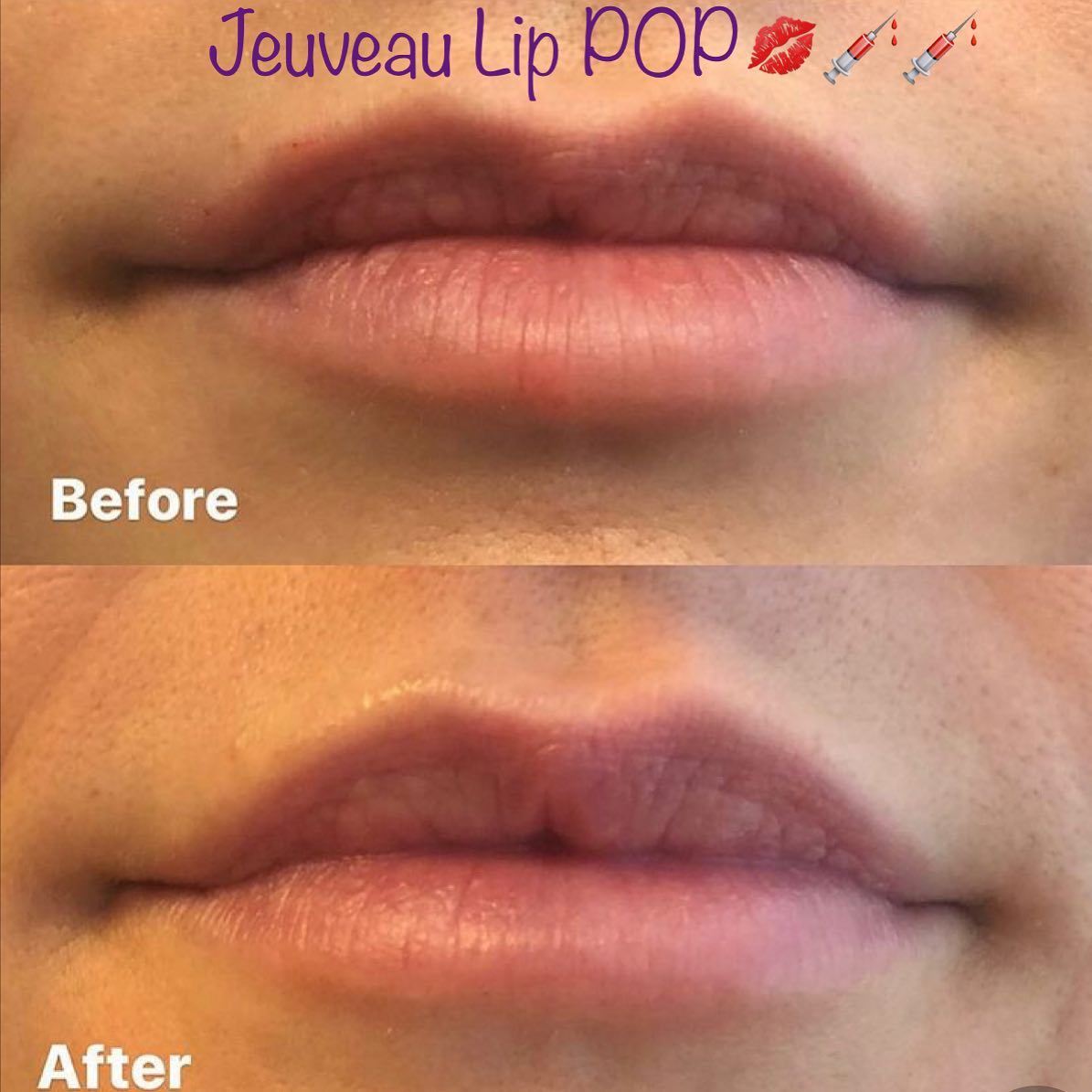 Lip filler before and after — added volume, definition and hydration — Sonoran Skin Renewal, Scottsdale AZ