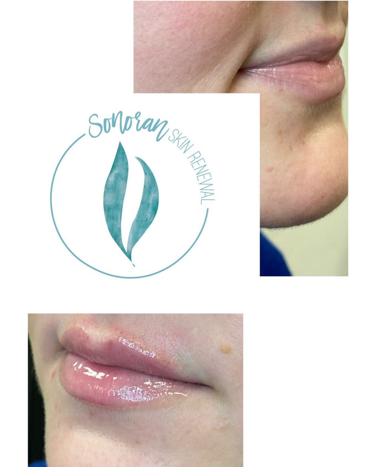 Lip flip before and after — more upper-lip show without filler — Sonoran Skin Renewal, Scottsdale AZ