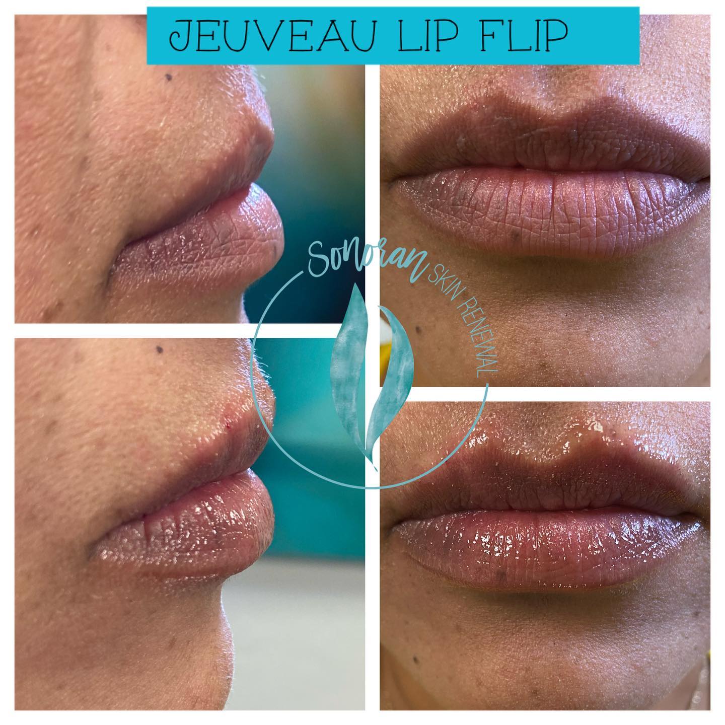 Lip flip before and after — more upper-lip show without filler — Sonoran Skin Renewal, Scottsdale AZ