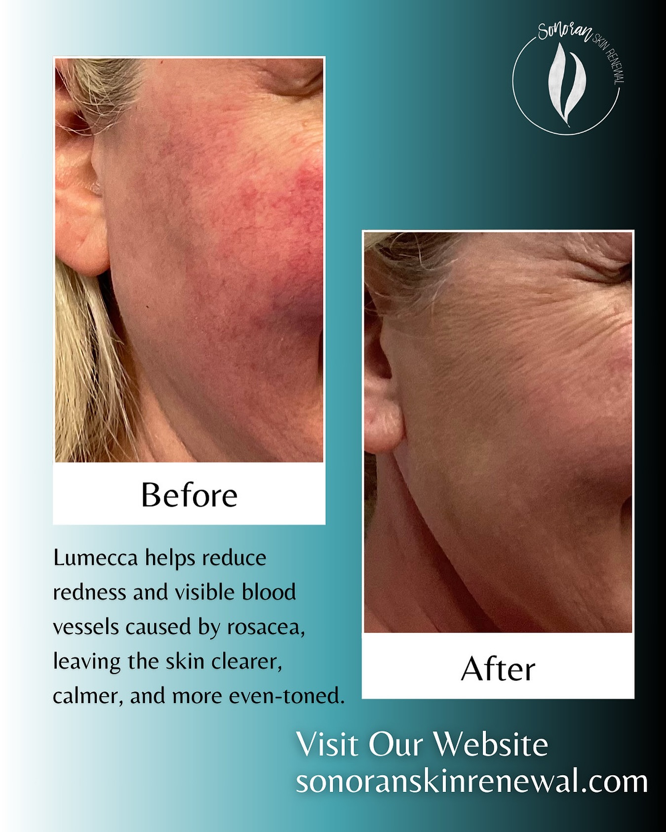 Lumecca IPL before and after — reduced facial redness and broken capillaries — Sonoran Skin Renewal, Scottsdale AZ