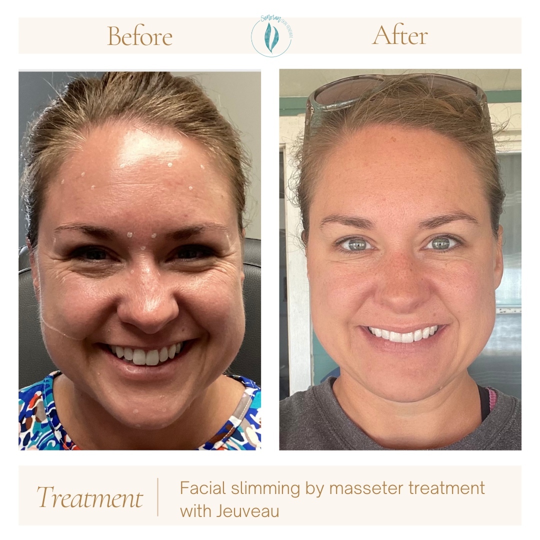 Masseter Botox before and after — slimmer lower face and softer jaw — Sonoran Skin Renewal, Scottsdale AZ