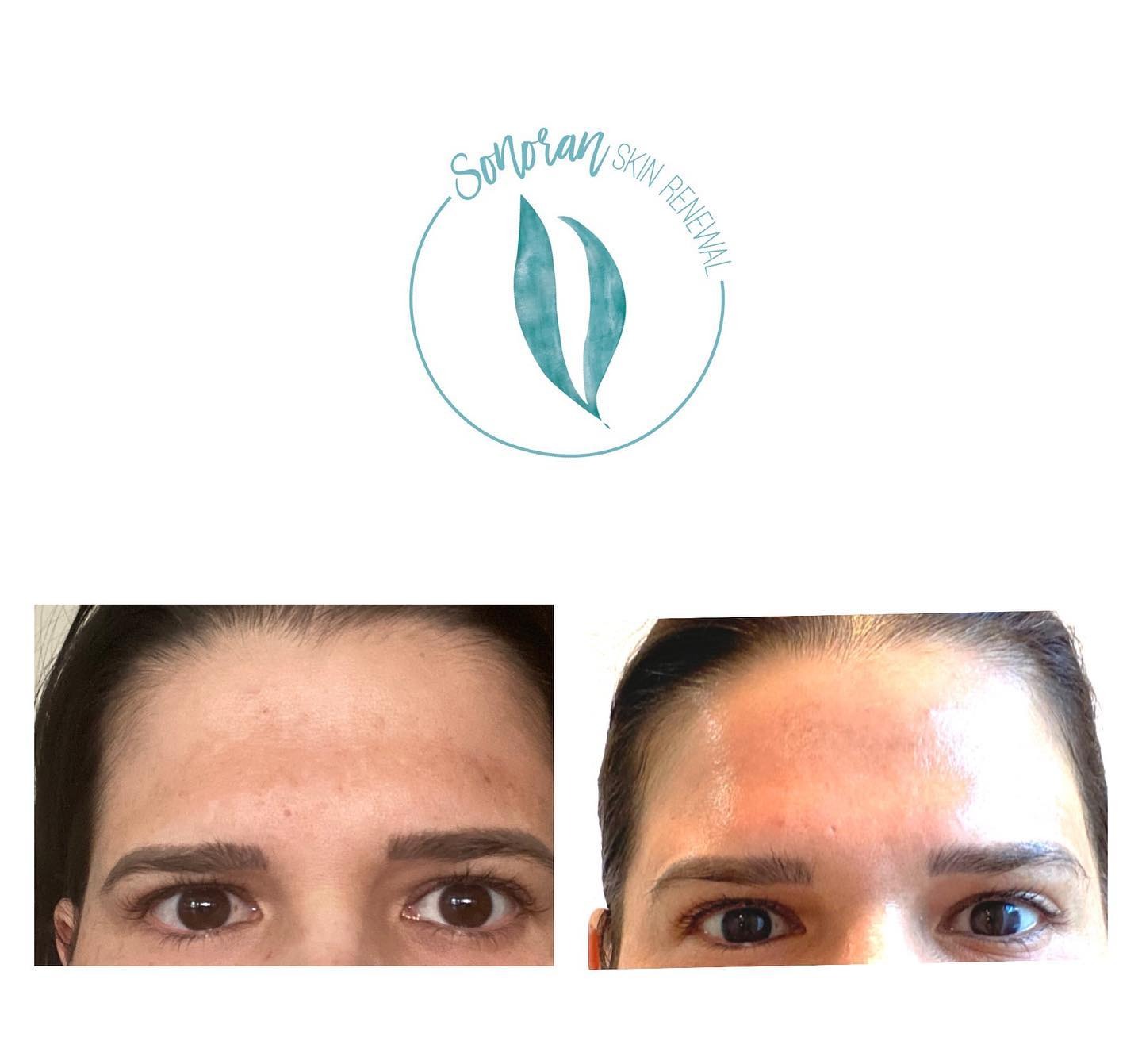 Medical-grade skincare before and after — clearer, brighter, more even skin — Sonoran Skin Renewal, Scottsdale AZ
