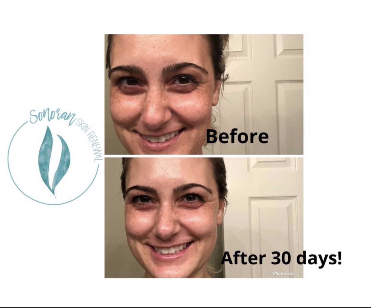 Medical-grade skincare before and after — clearer, brighter, more even skin — Sonoran Skin Renewal, Scottsdale AZ
