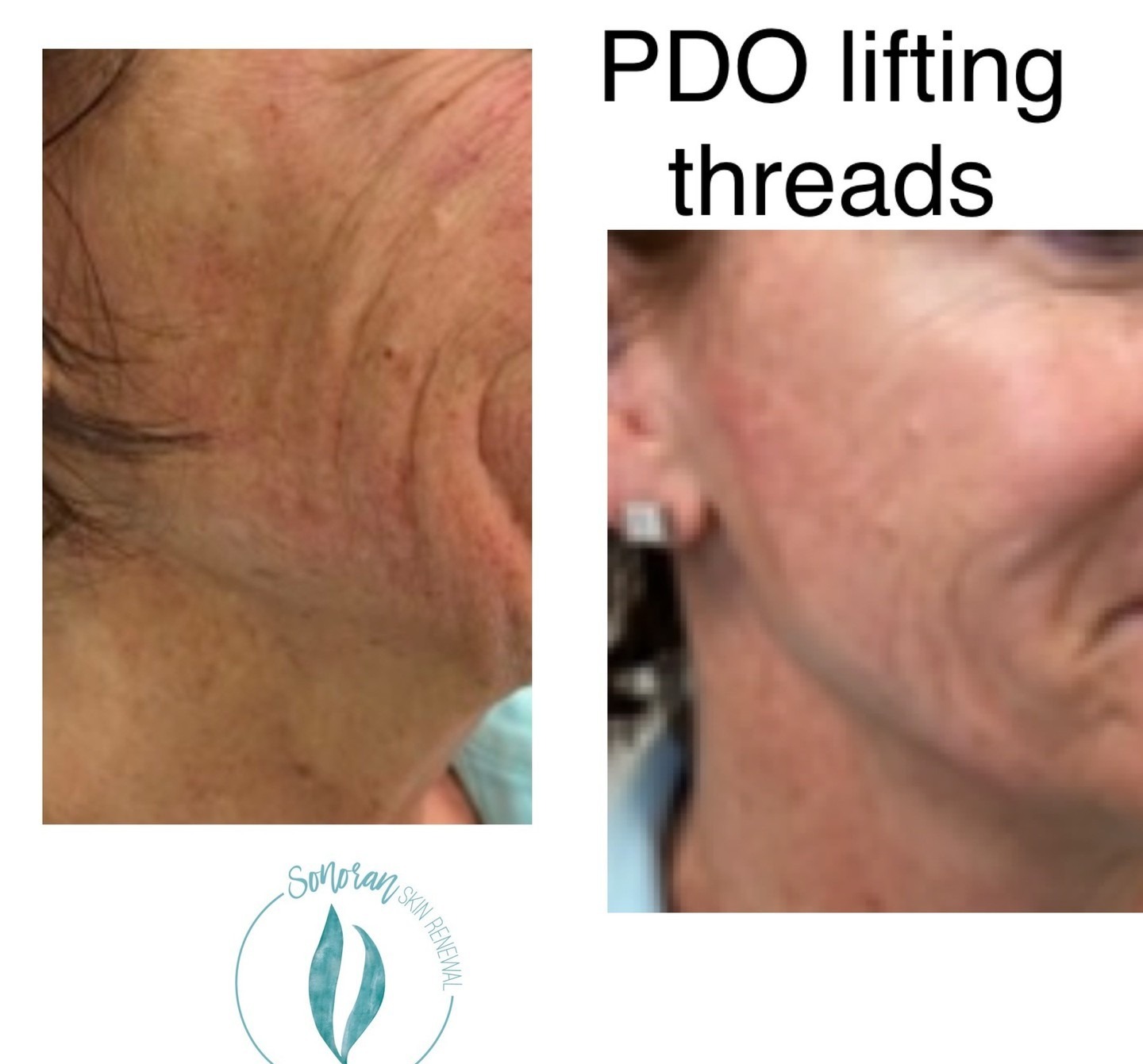 PDO thread lift before and after — lifted, tightened contour — Sonoran Skin Renewal, Scottsdale AZ