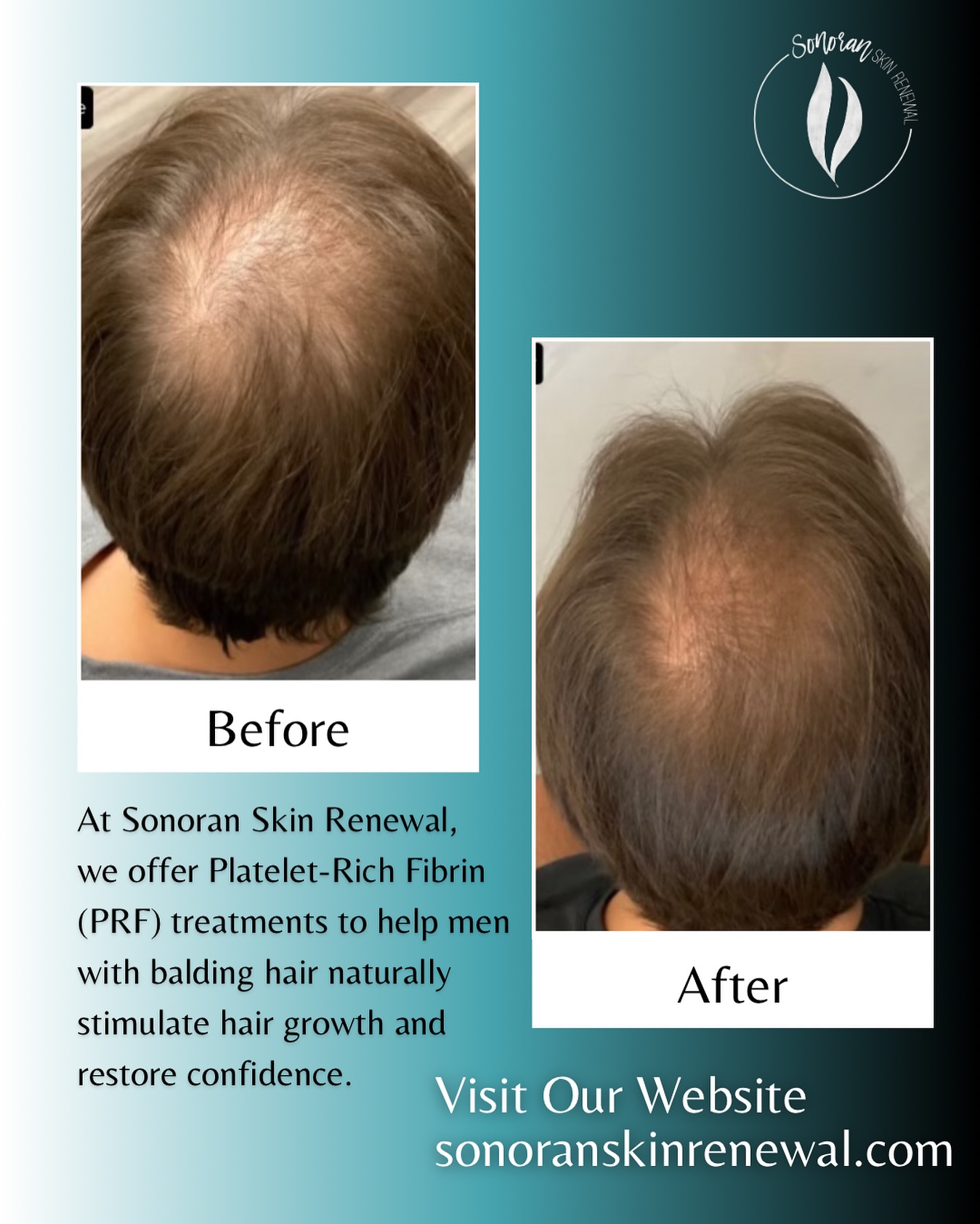 PRF hair restoration before and after — denser, thicker regrowth — Sonoran Skin Renewal, Scottsdale AZ
