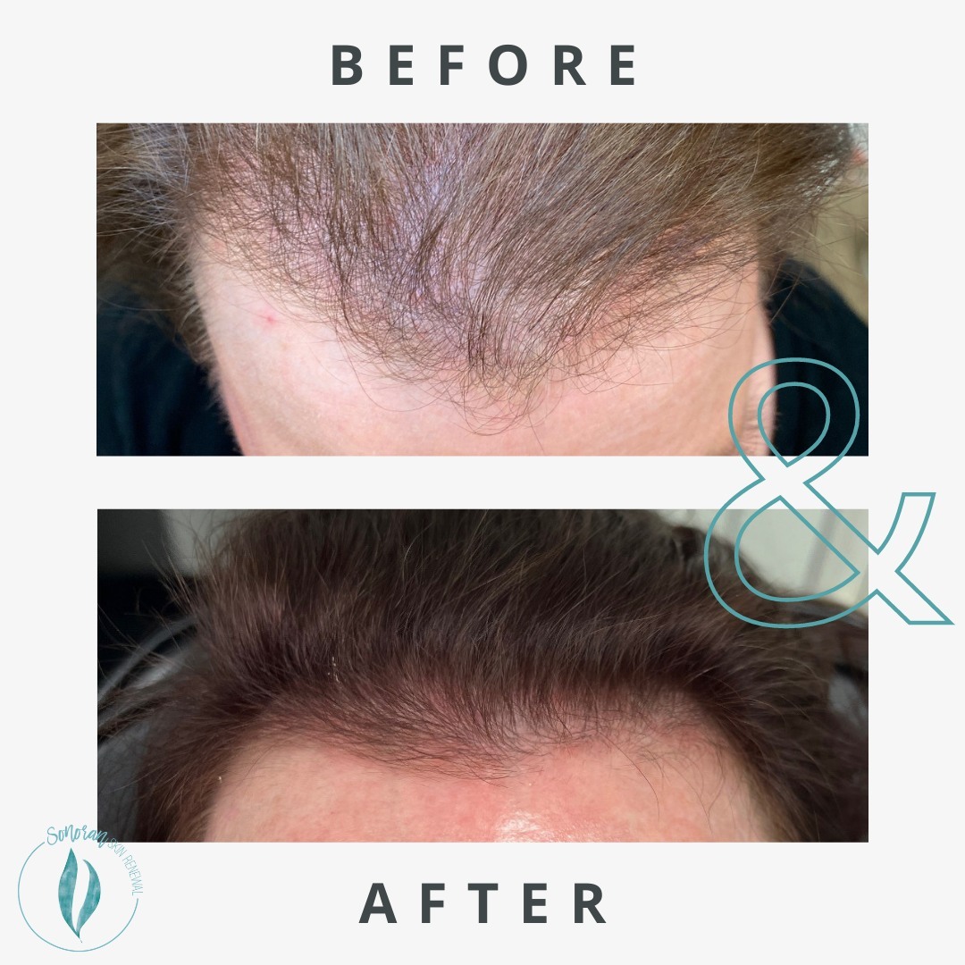 PRF hair restoration before and after — denser, thicker regrowth — Sonoran Skin Renewal, Scottsdale AZ