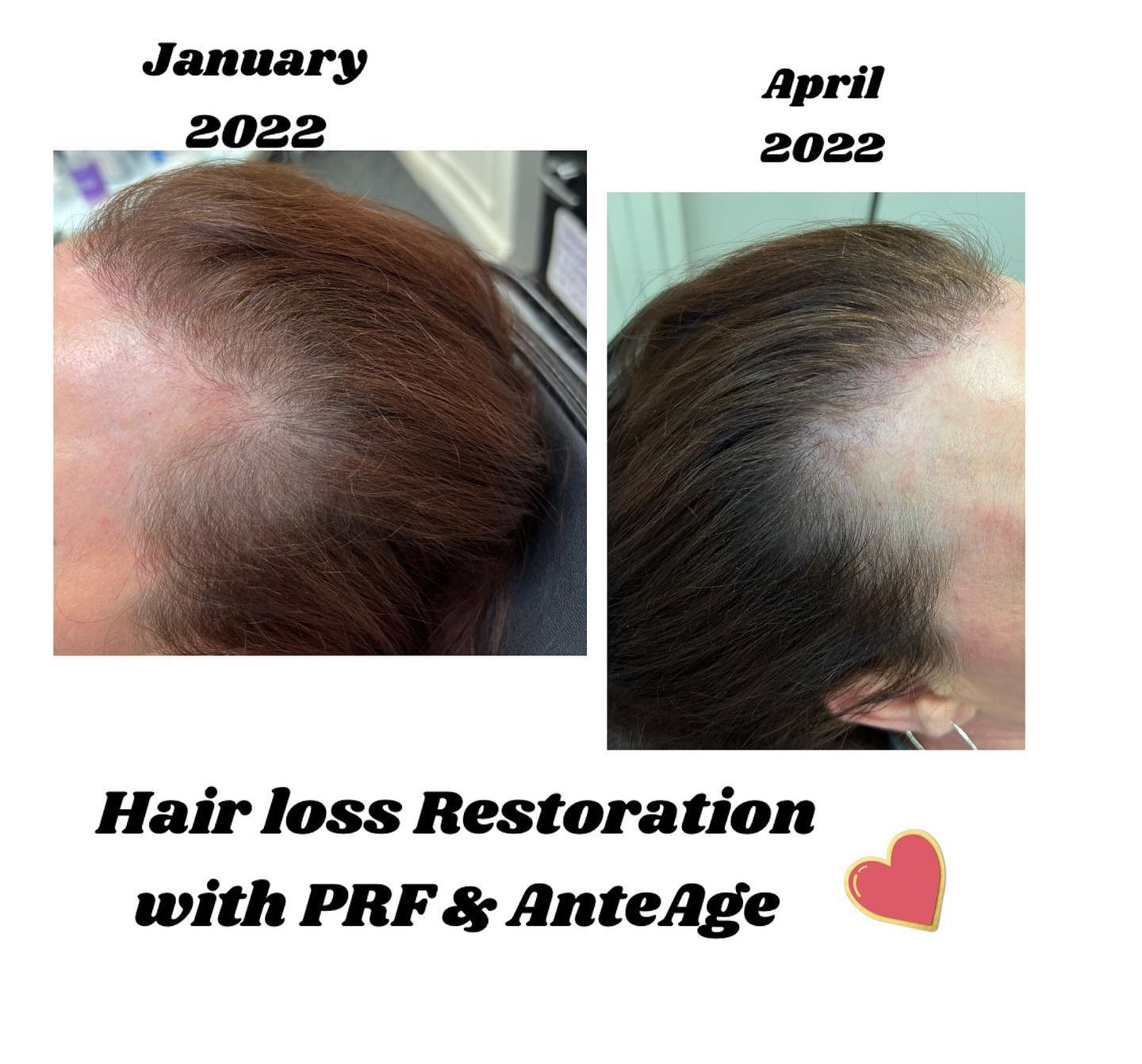 PRF hair restoration before and after — denser, thicker regrowth — Sonoran Skin Renewal, Scottsdale AZ