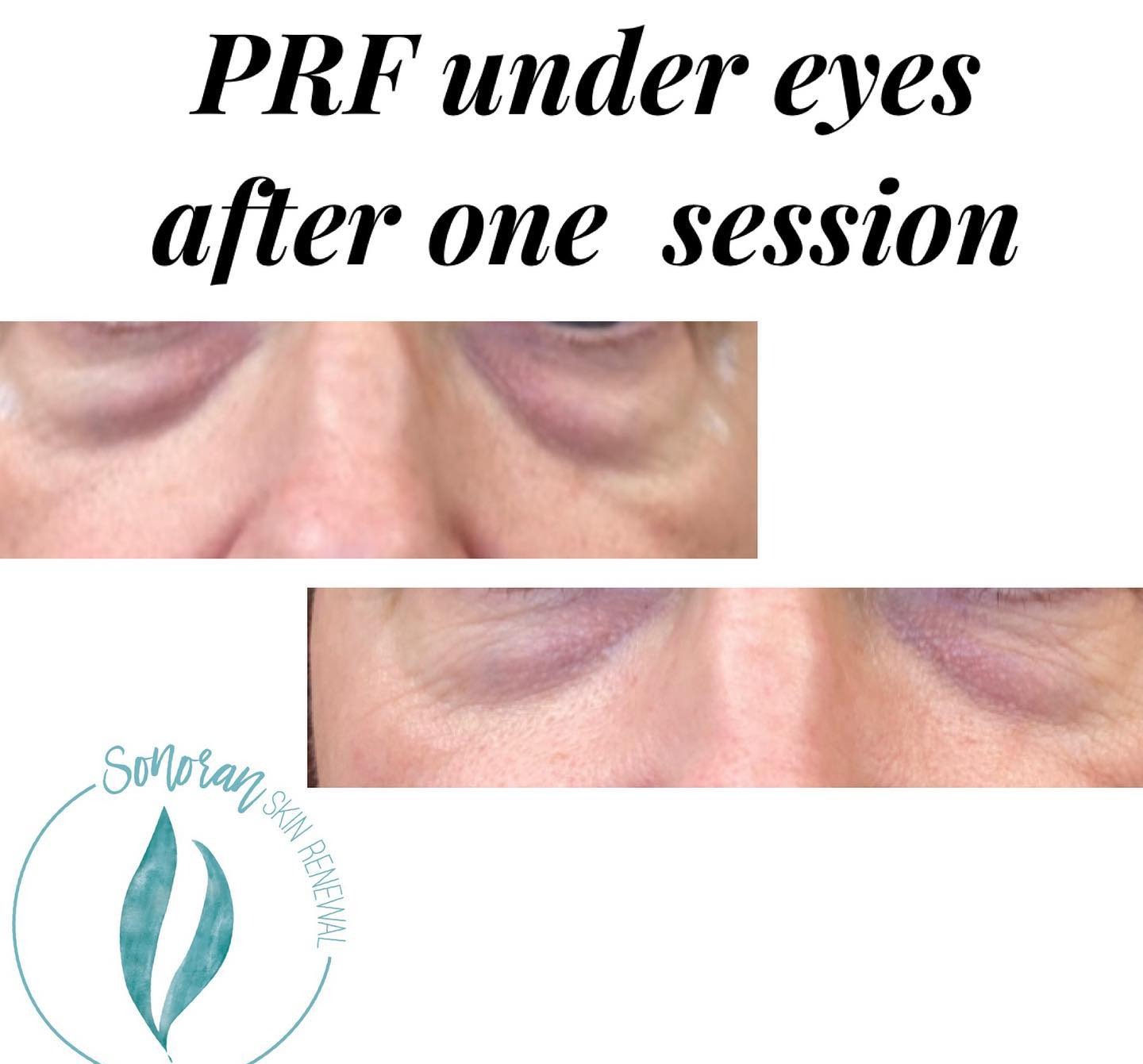 PRF under-eye before and after — brighter, fuller under-eye area — Sonoran Skin Renewal, Scottsdale AZ