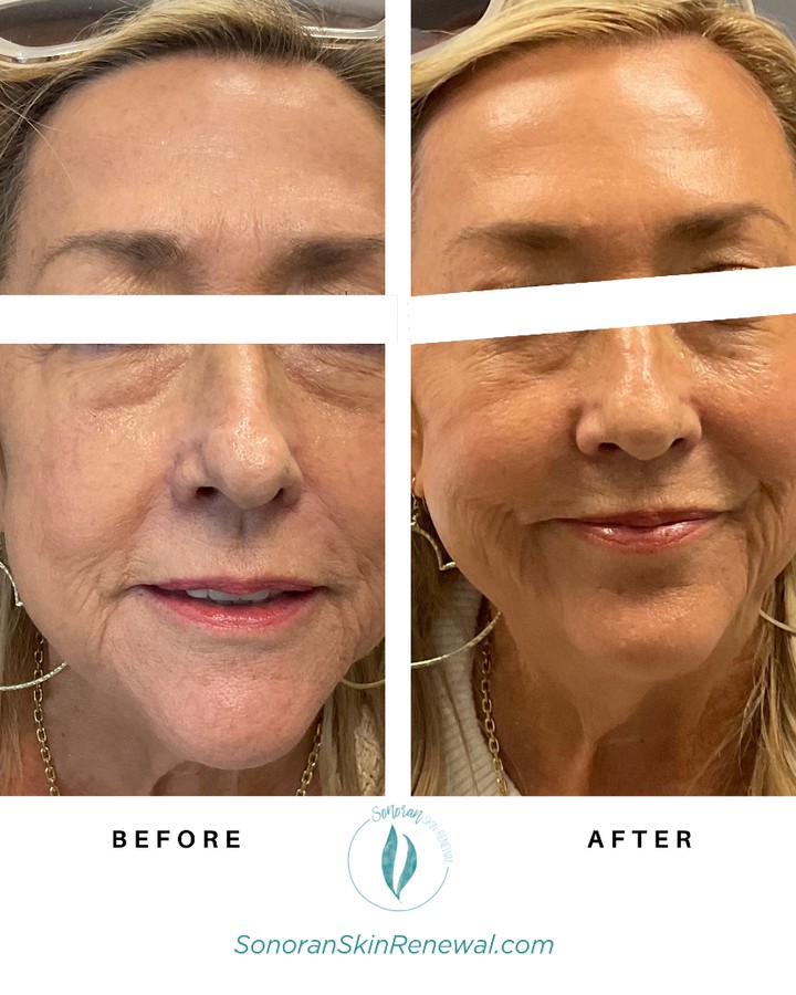 Radiesse before and after — restored volume and collagen stimulation — Sonoran Skin Renewal, Scottsdale AZ
