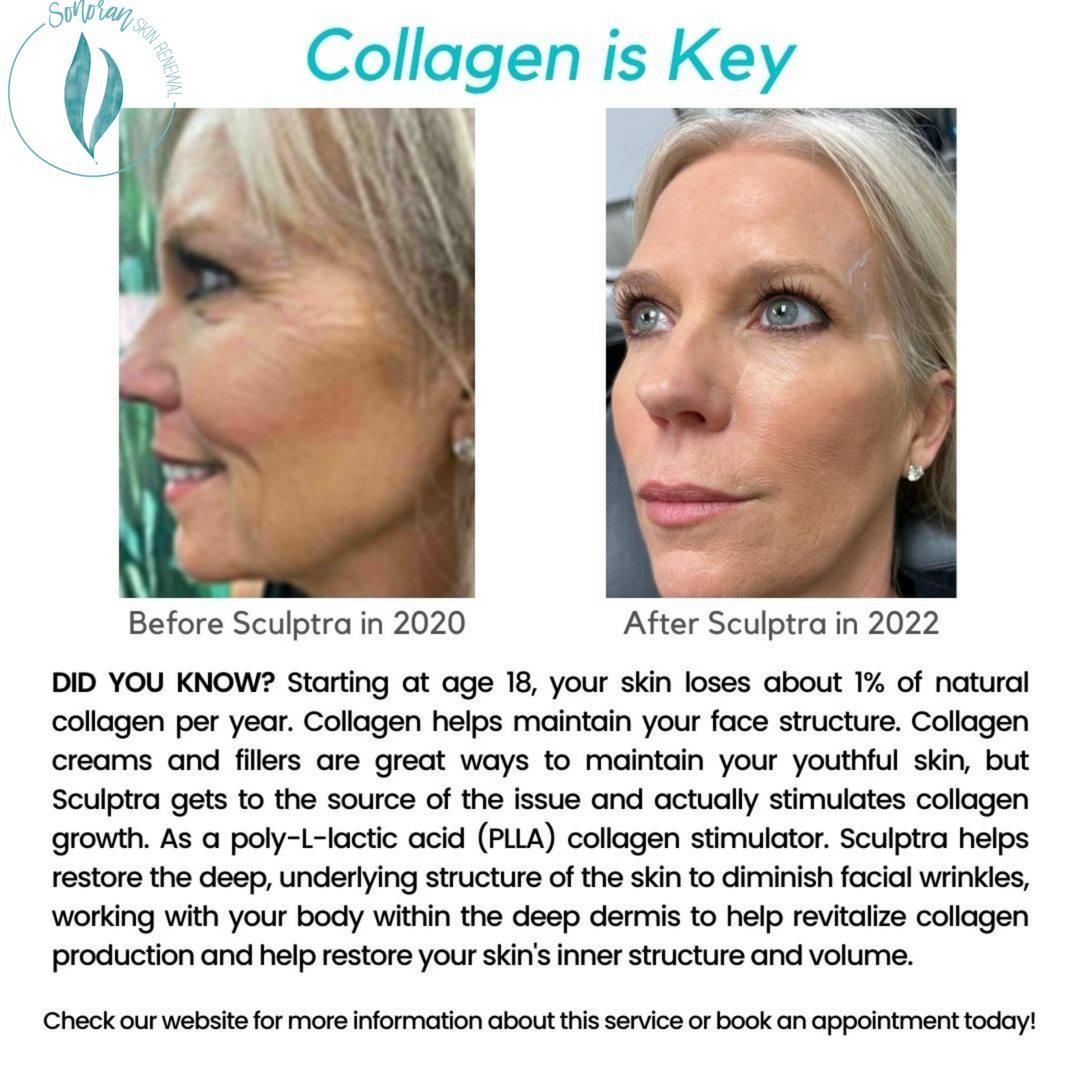 Sculptra before and after — gradual collagen rebuilding — Sonoran Skin Renewal, Scottsdale AZ