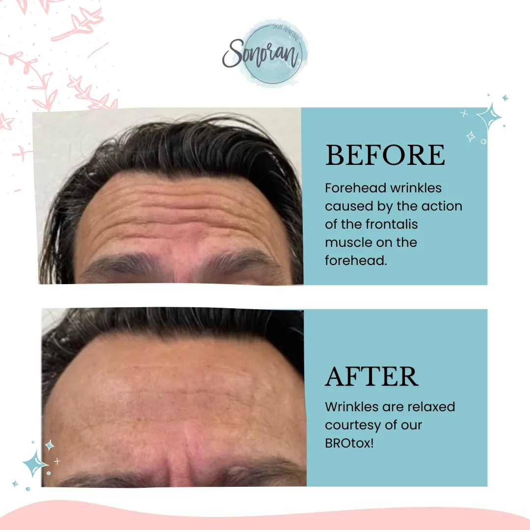 Botox for men before and after — smoother forehead, still masculine — Sonoran Skin Renewal, Scottsdale AZ