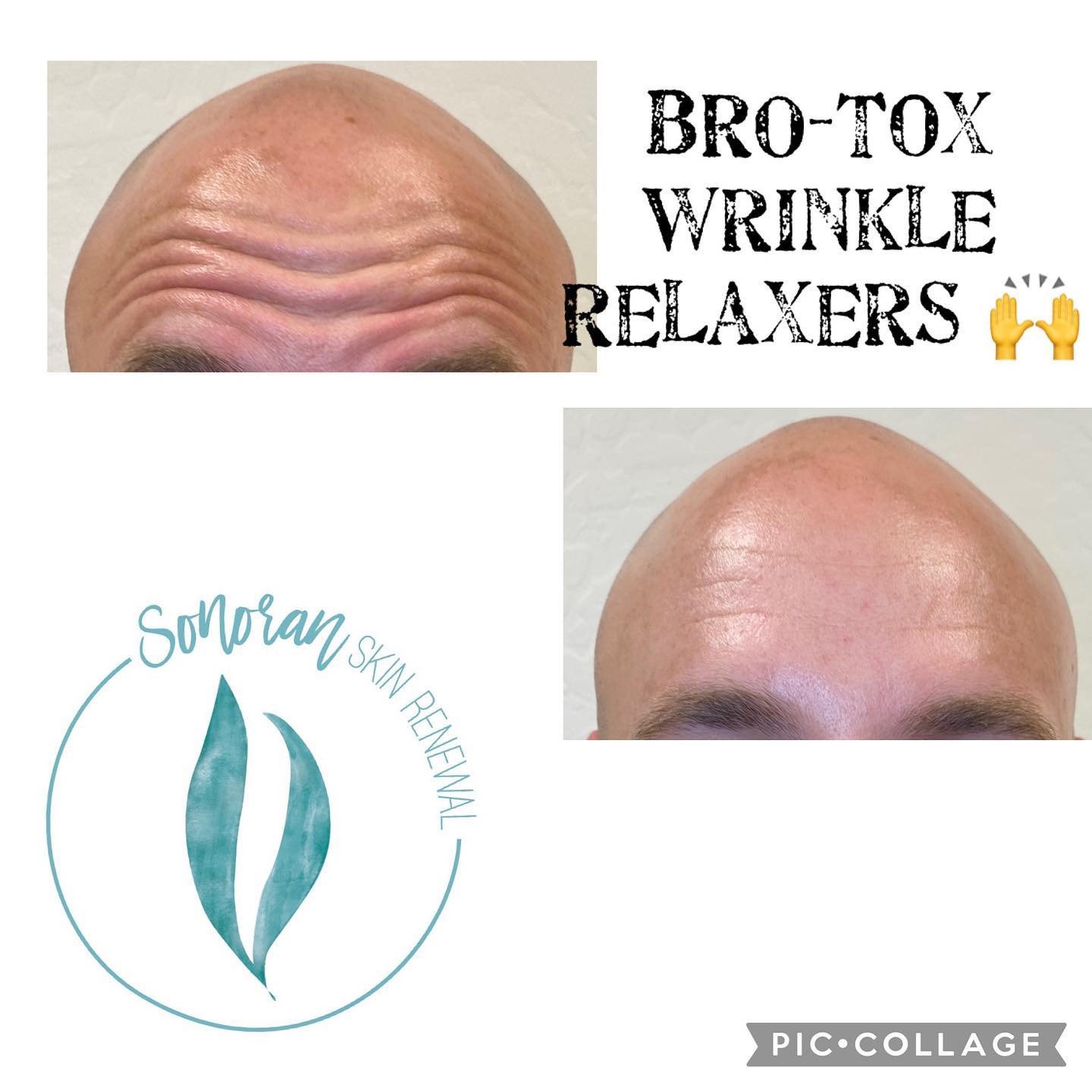 Botox for men before and after — smoother forehead, still masculine — Sonoran Skin Renewal, Scottsdale AZ