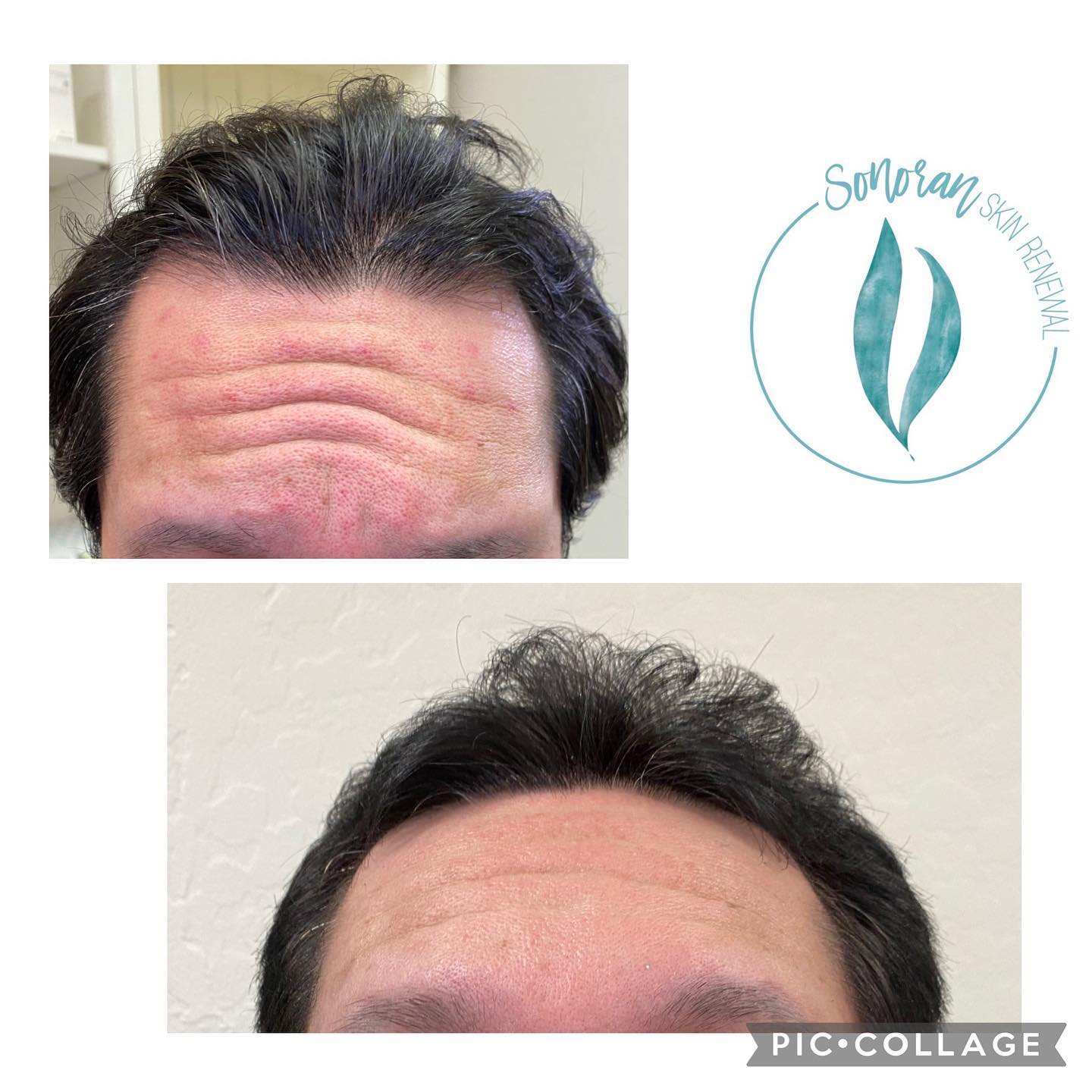 Botox for men before and after — smoother forehead, still masculine — Sonoran Skin Renewal, Scottsdale AZ