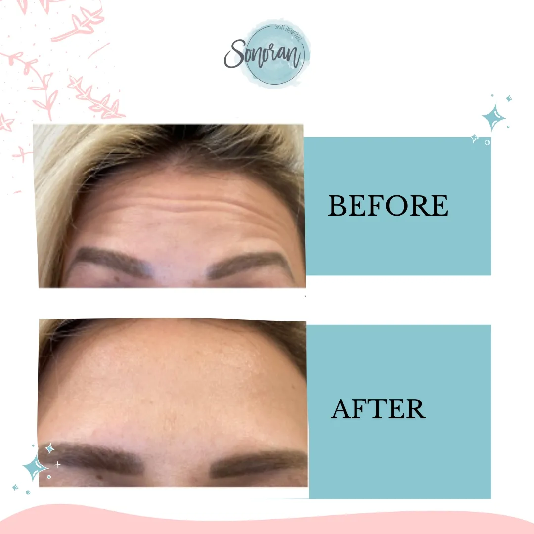 Botox before and after — softened forehead lines and frown lines — Sonoran Skin Renewal, Scottsdale AZ