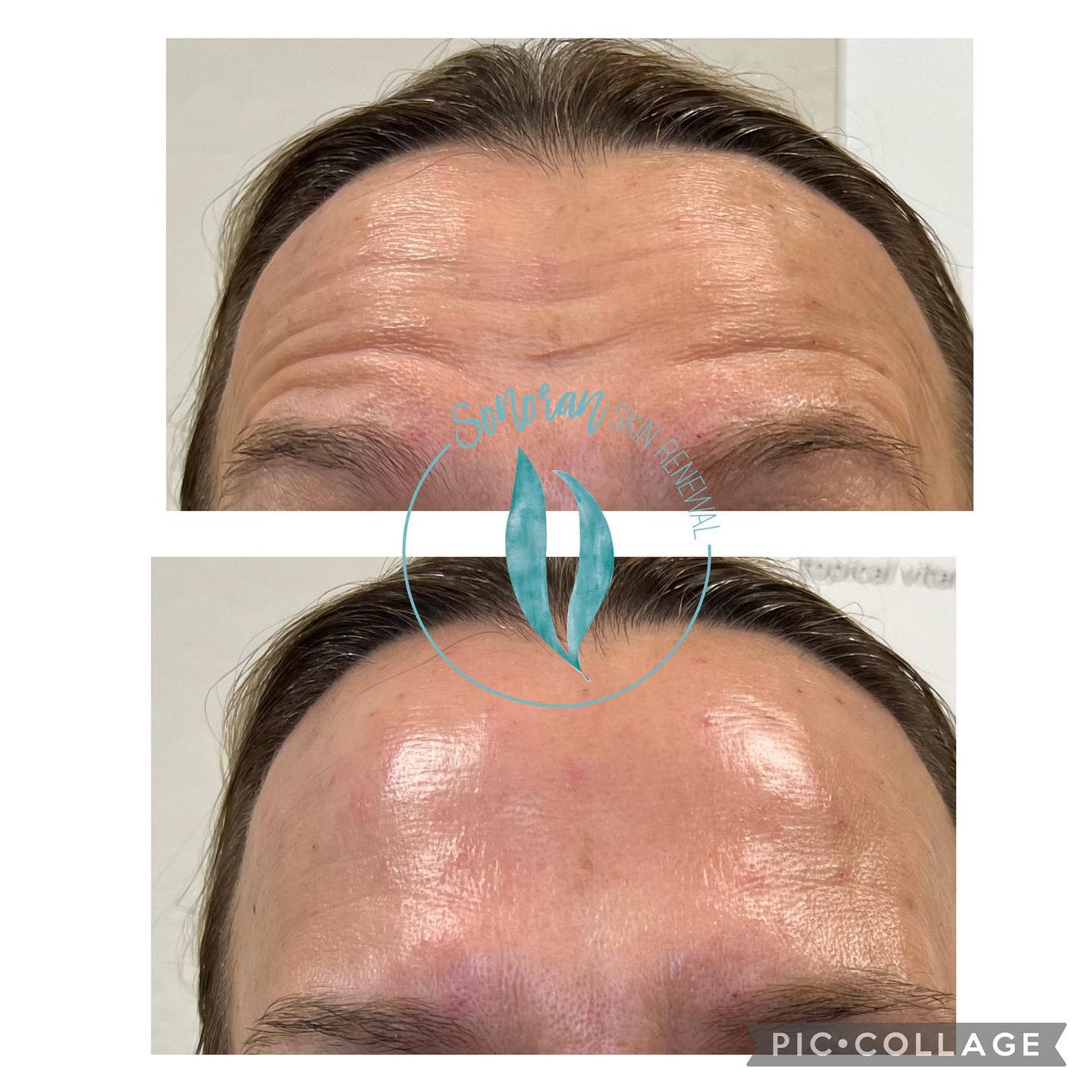 Botox before and after — softened forehead lines and frown lines — Sonoran Skin Renewal, Scottsdale AZ