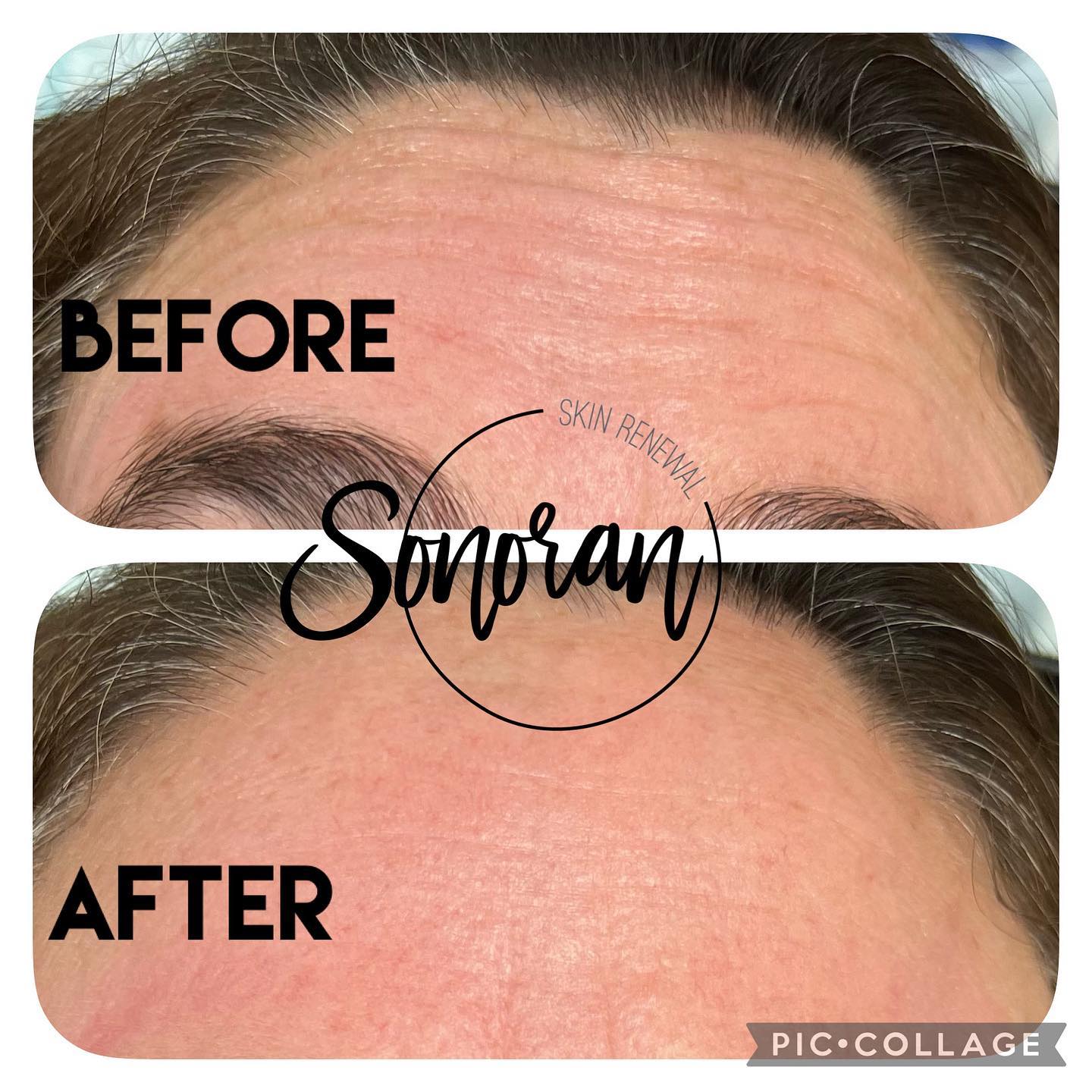 Botox before and after — softened forehead lines and frown lines — Sonoran Skin Renewal, Scottsdale AZ