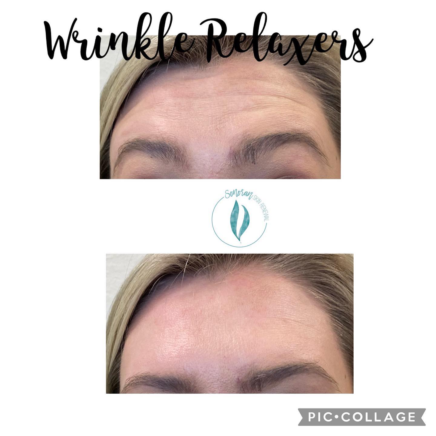 Botox before and after — softened forehead lines and frown lines — Sonoran Skin Renewal, Scottsdale AZ