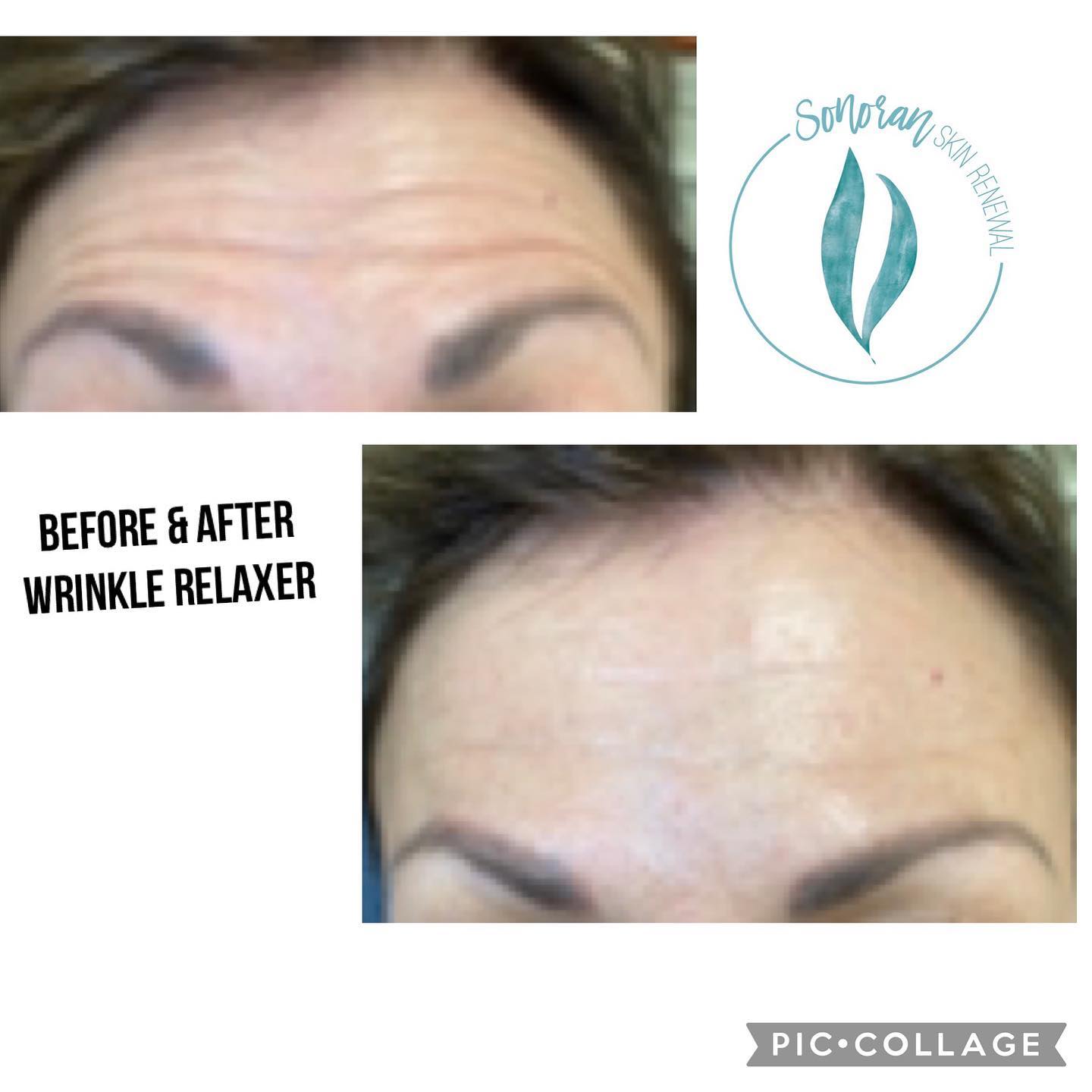 Botox before and after — softened forehead lines and frown lines — Sonoran Skin Renewal, Scottsdale AZ
