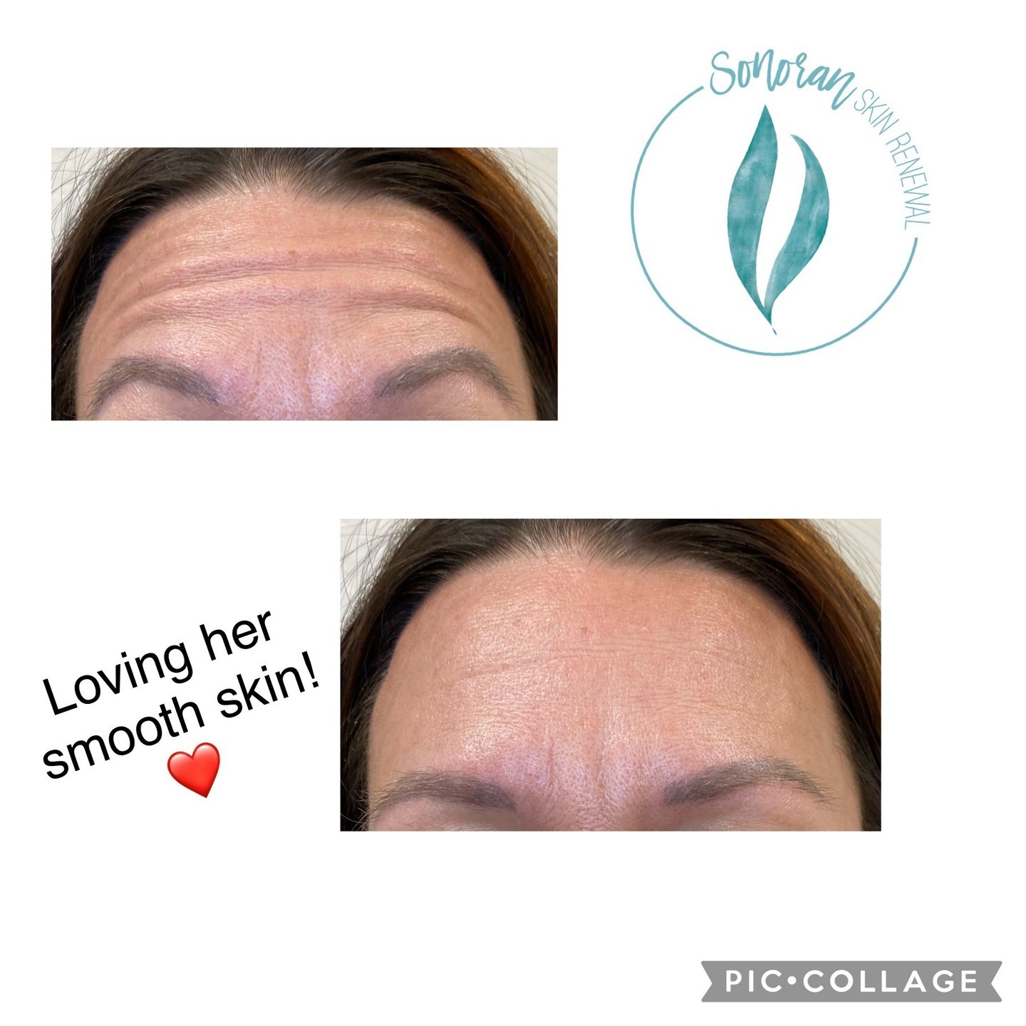 Botox before and after — softened forehead lines and frown lines — Sonoran Skin Renewal, Scottsdale AZ