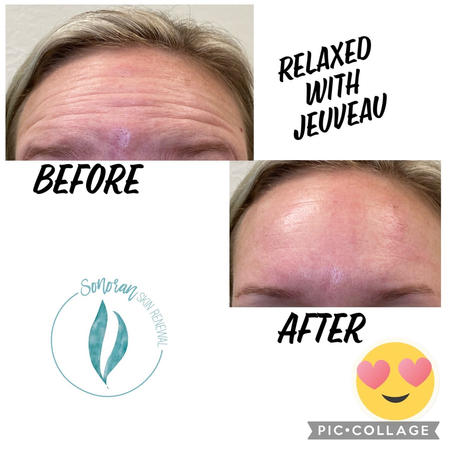 Botox before and after — softened forehead lines and frown lines — Sonoran Skin Renewal, Scottsdale AZ