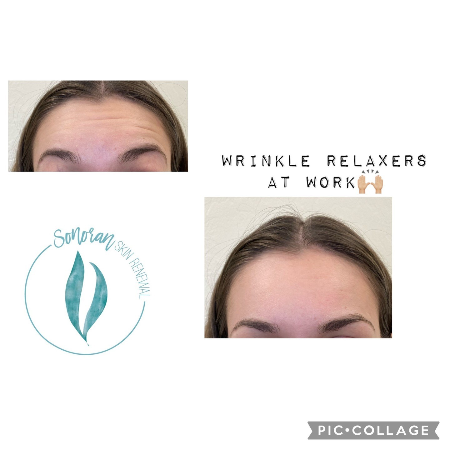 Botox before and after — softened forehead lines and frown lines — Sonoran Skin Renewal, Scottsdale AZ