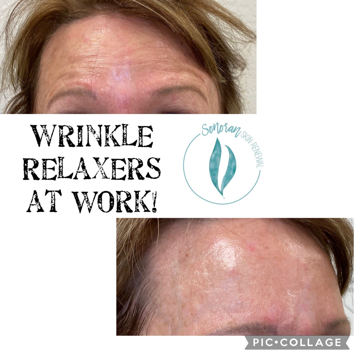 Botox before and after — softened forehead lines and frown lines — Sonoran Skin Renewal, Scottsdale AZ