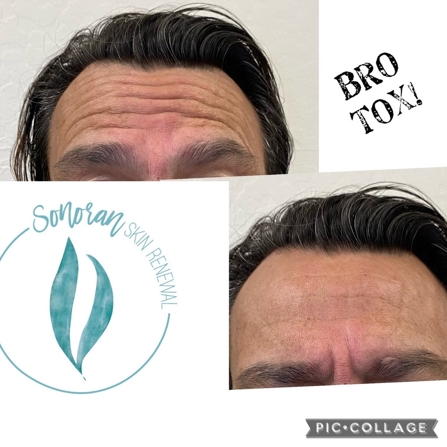 Botox before and after — softened forehead lines and frown lines — Sonoran Skin Renewal, Scottsdale AZ