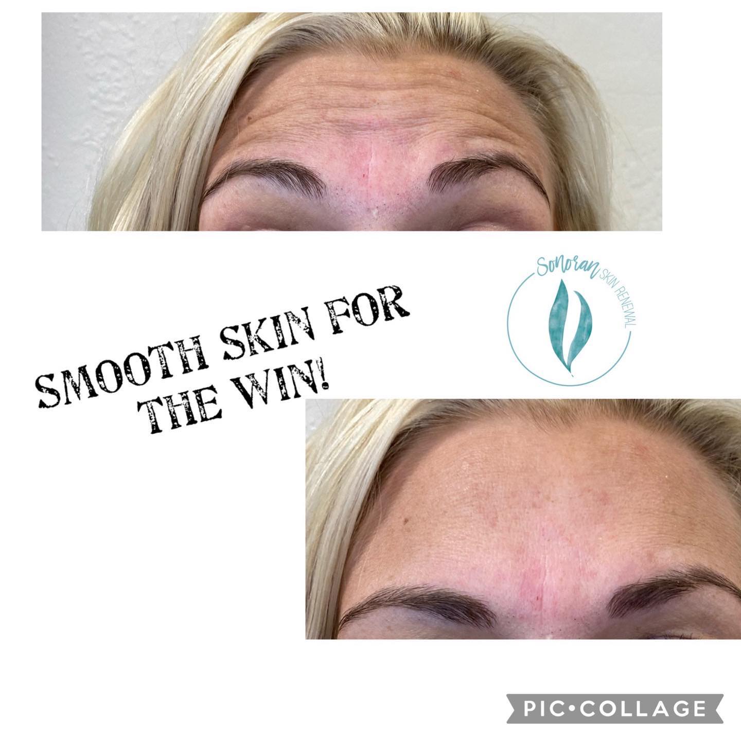 Botox before and after — softened forehead lines and frown lines — Sonoran Skin Renewal, Scottsdale AZ